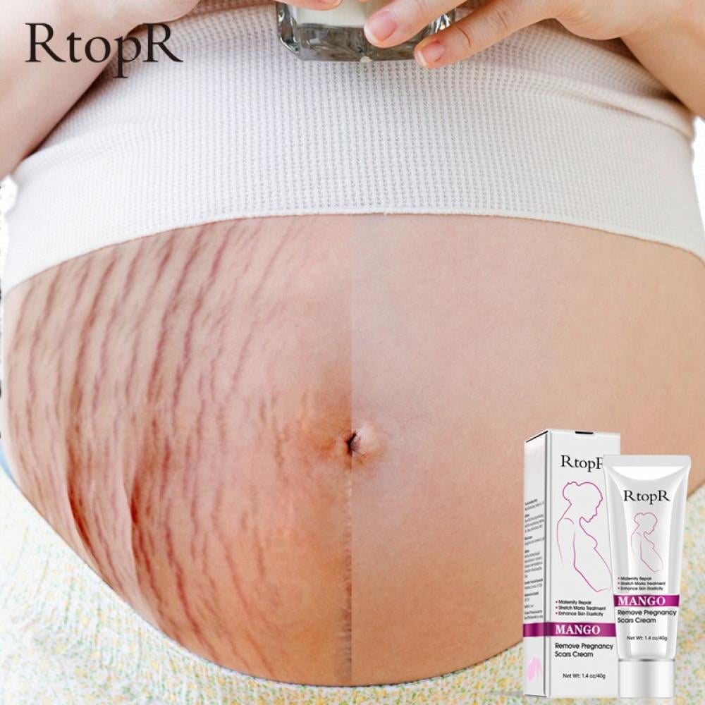 30g Pregnancy Stretch Mark Repair Cream Maternity Obesity Skin Postpartum  Stretch Scar Body Marks Remover Smooth Skin Care