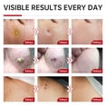 thumbnail image 4 of Líquido eliminador de verrugas QQE con un 20% de ácido salicílico para varias piezas, 4 of 8