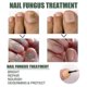 thumbnail image 3 of Líquido para tratamiento de hongos en las uñas shaofei EELHOE 30 ml, 3 of 4