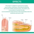 thumbnail image 4 of Tratamiento de hongos en las uñas de los pies Solución antimicótica Reparación de uñas de los pies y las manos, 4 of 5