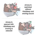 thumbnail image 3 of Adjustable Mouth With Silicone Anti-snoring Device Tw, 3 of 3