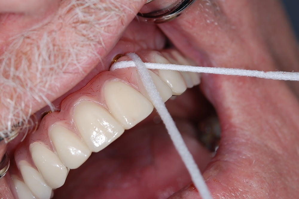 DentaGama on X: Superfloss can clean around braces, implants, bridges or  wide gaps. It consists of a stiff end, making it easy to insert between  braces and under retainers. Attached to the