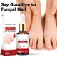 thumbnail image 2 of Tratamiento de hongos para uñas, suero esencial para la eliminación de hongos en los pies, onicomicosi, productos para el cuidado antiinfección, 2 of 5