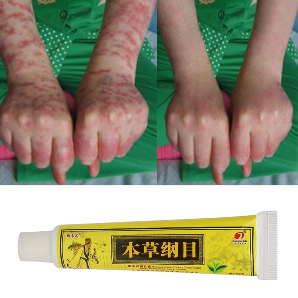 LA TALUS Natural Herbal Cream for Eczema Dermatitis Scabies Itching