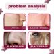 thumbnail image 4 of Liquidación Sin reembolso Sin cambio Esencia de ácido tartárico Jaysuing Eliminación de puntos negros y acné Diluye la viruela Aclara y reduce los poros - 30 ml en caja, 4 of 4