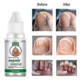 thumbnail image 3 of Nail Fungus Treat Onychomycosis Toe Care Nail Repair -, 3 of 5