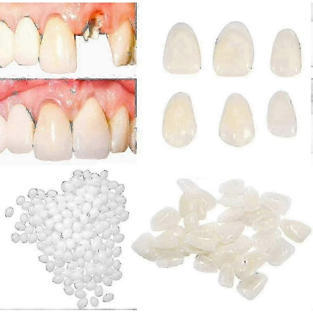 2pcs Temporary Tooth Repair Kit For Filling The Missing Broken Tooth And Gaps-moldable Fake Teeth.