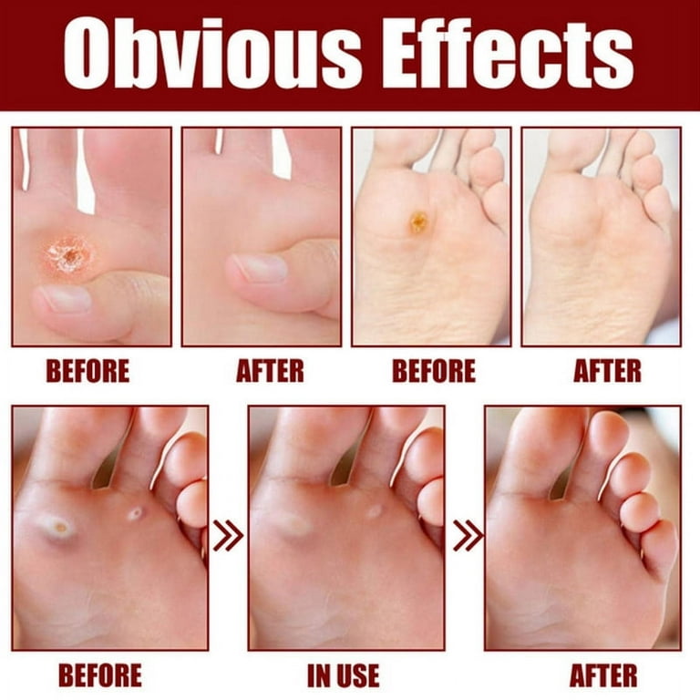 Foot Corn Removal Extra Strengthen Gel, Liquid Corn and Callus