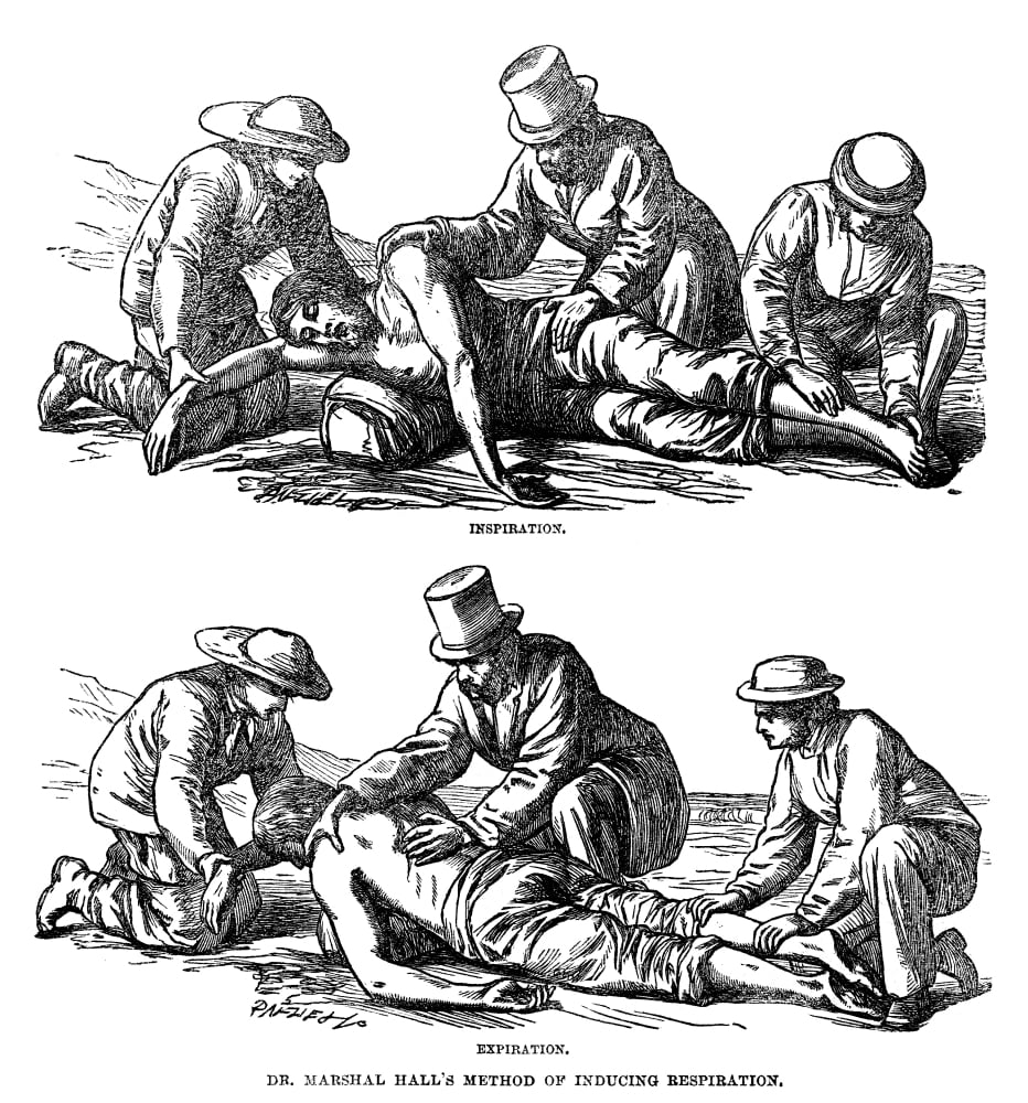 Artificial Respiration, 1864. /Ndr. Marshall Hall'S Method For