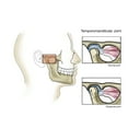 thumbnail image 2 of Temporomandibular joint  normal and dislocated. Poster Print by TriFocal Communications/Stocktrek Images, 2 of 2