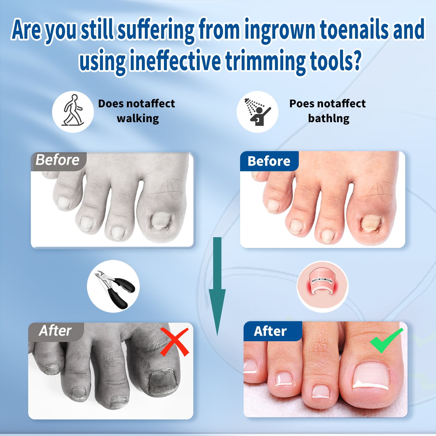Ingrown Toenail Removal Kit  Professional Tools for Ingrown Toenail Treatment with Nail Clippers, Pusher, File & Corrector  Cure & Prevent Painful Ingrown Nails for Toes & Fingers