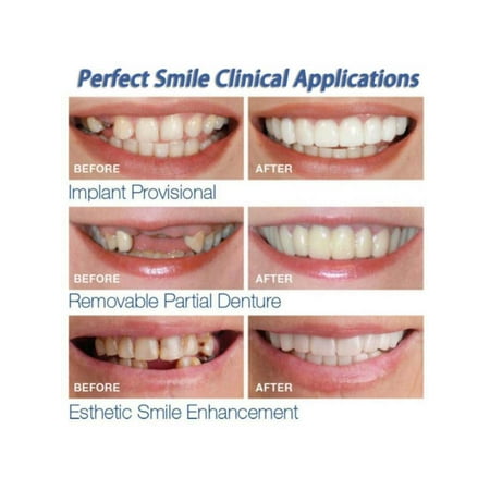 VICOODA Temporary Denture,Teeth Cosmetic,Denture Teeth Top Veneer 1PCS