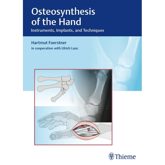Osteosynthesis of the Hand: Instruments, Implants, and Techniques, (Hardcover)