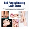 thumbnail image 2 of Laser Nail Fungus Remover Tool for Toenail and Foot Repair Treatment Kit, 2 of 5