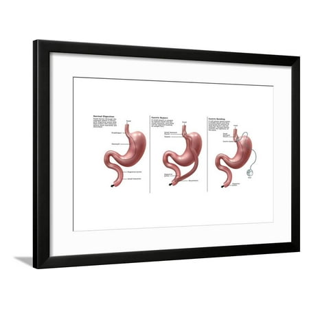 Framed Bypass Light Digestive System: Normal, Gastric Band, Bypass Framed Print Wall Art By Gwen Shockey ()