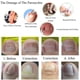 thumbnail image 5 of Parche de ortodoncia para uñas encarnadas Corrector de uñas de los pies elástico cuidado de la salud de los pies 10 Uds., 5 of 6