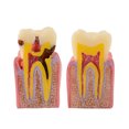 thumbnail image 4 of Dental Tooth Decay Model 6 Times Dental Caries Teeth Model, 4 of 7
