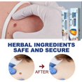 thumbnail image 4 of Wart removal cream 20Fast-acting gel warts ACareOintment suitable for face, hands, feet and body, 4 of 5