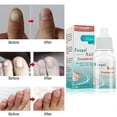 thumbnail image 4 of 2PCS LANTHOME Fungal Liquid Nail Treatment Nail And Foot Whitening Toenail Fungu 10ml, 4 of 5