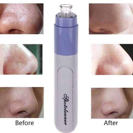 Electric Suction Facial Device Acne Blackhead Remover Pore Cleansing Beauty Device