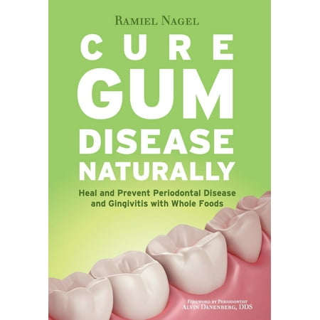 Cure Gum Disease Naturally : Heal Gingivitis and Periodontal Disease with Whole (Best Cure For Gum Disease)