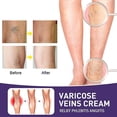 thumbnail image 2 of Crema para varices, alivio de varices en piernas, fortalecimiento de la salud capilar, crema para el cuidado de las arañas vasculares, 2 of 5