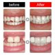thumbnail image 4 of Juego de mordedores moldeables Jaysuing, maquillaje de fiesta, relleno temporal de cavidades dentales, modificación de dentaduras postizas |, 4 of 5