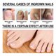 thumbnail image 3 of Nail Help Aceite de tratamiento de corrección de uñas encarnadas, gotas para uñas encarnadas, suavizante de uñas para un fácil recorte (10 ml) kaili Sencillez, 3 of 5
