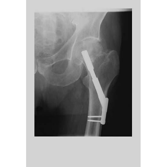 Fixed Femur-Fine Art Canvas Print (20" x 30")