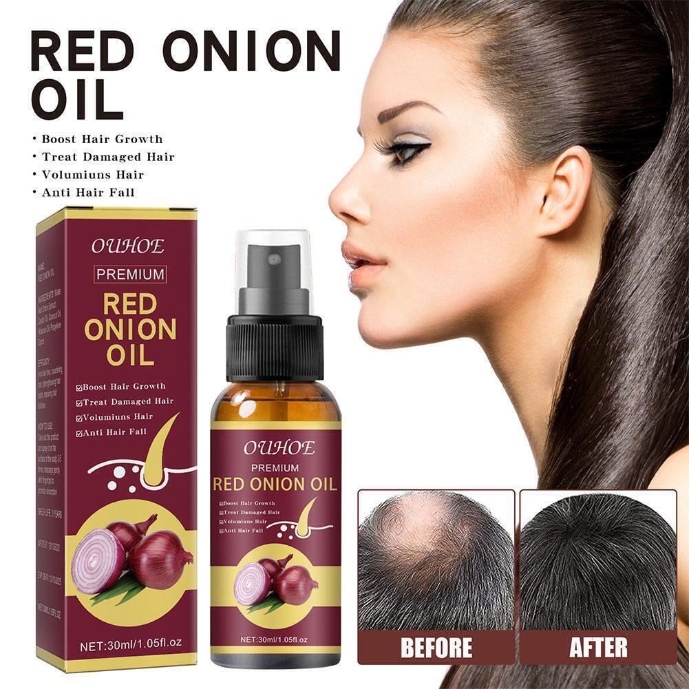 Urbangabru 100% Natural Onion Oil for Hair Regrowth and Hair Fall –  GlobalBees Shop