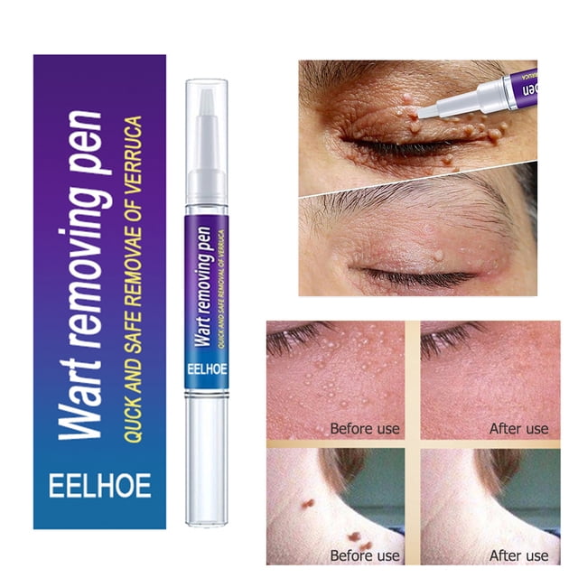 Yeso De Eliminación De Verrugas Crema de tratamiento corporal para eliminación de verrugas, removedor de marcas en la piel, yeso medicinal a base de hierbas Sywqhk Cuidado Belleza