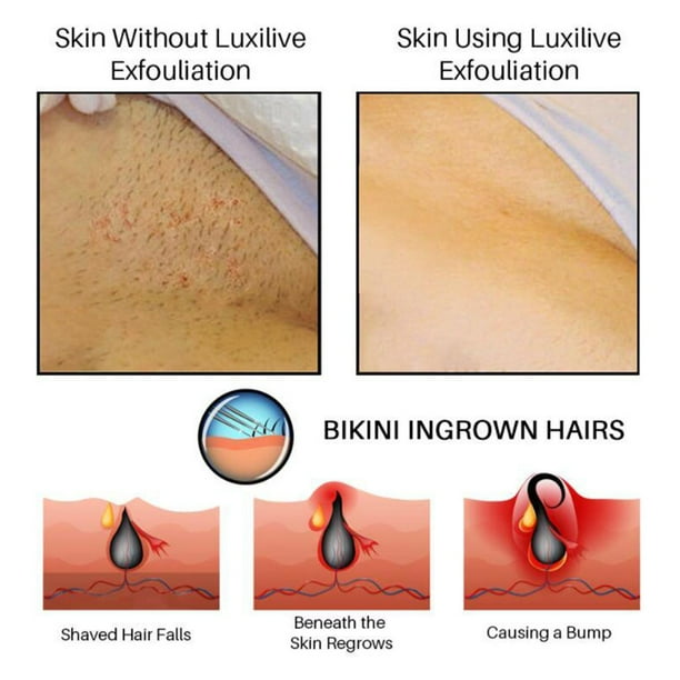 Piel Vellos Encarnados En La Axila Como Sacar Pelos Encarnados De