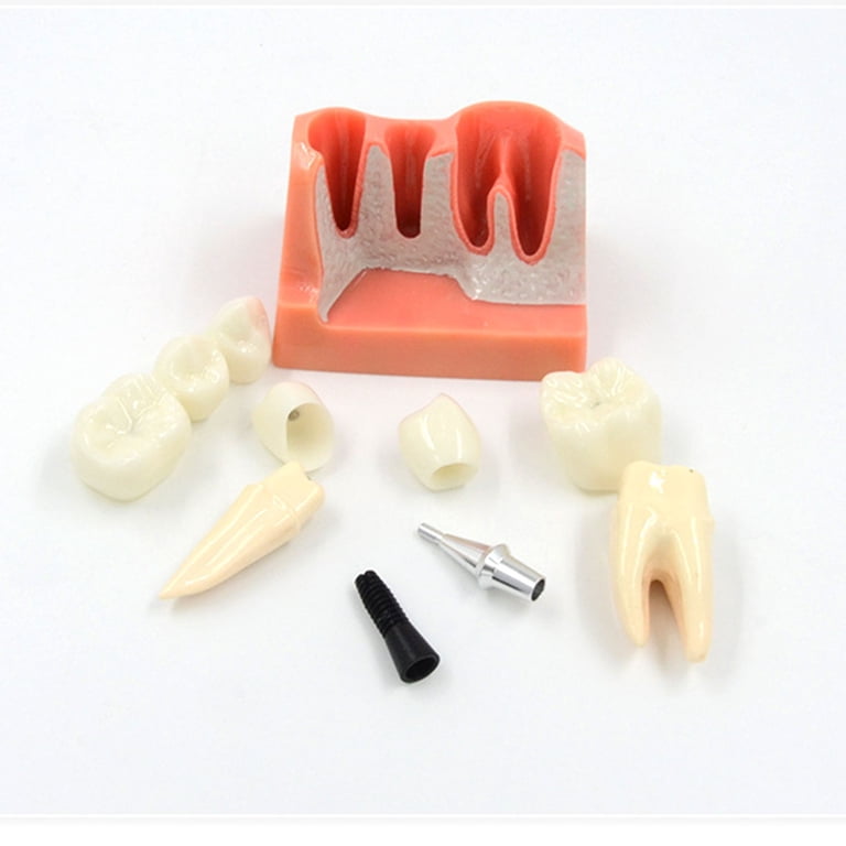 Dental Implant Analysis Crown Bridge Demonstration Model - Teaching & Practice Tool