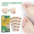 thumbnail image 2 of 100Pcs Ingrown Toenail Correction Stickers Nail Corrector Patches Nail Care Tools, 2 of 12