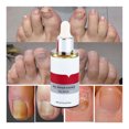 thumbnail image 2 of Tratamiento de hongos en las uñas Esencia para el cuidado de los pies Blanqueamiento de uñas y pies Eliminación de hongos en las uñas de los pies Gel Antiinfección Paroniquia Onicomicosis, 2 of 6