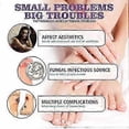 thumbnail image 3 of 3pcs 100ml Medinail Fungus Repair Spray For Foot,nail, Soft Nail, Yellow Hair Care, 3 of 5