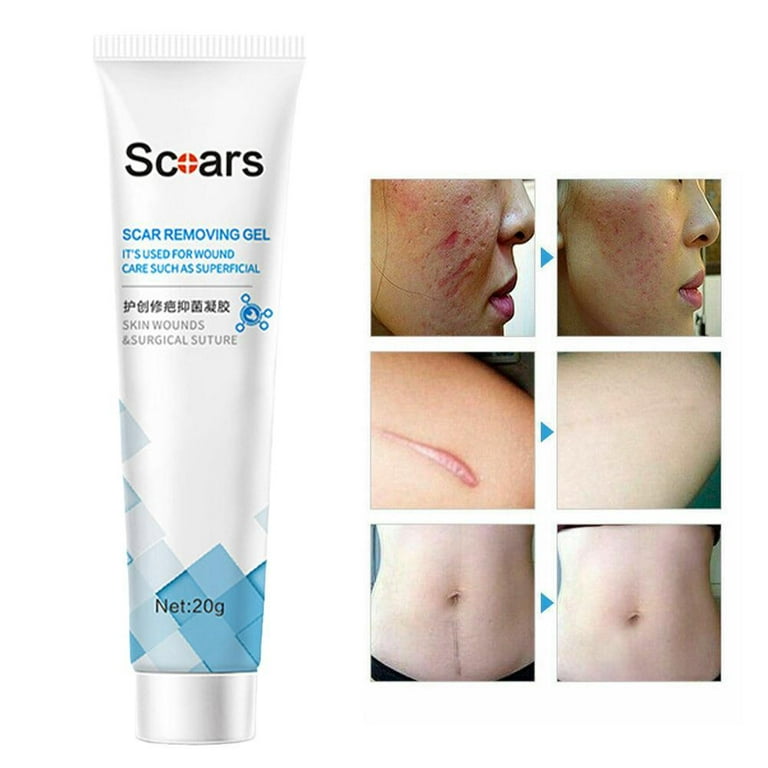 Acne Scar Removal Cream Gel Skin Care Stretch Marks Remove Acne Spots Surgical Beauty Cosmetics Whitening Treatment Smooth Scars V7S8