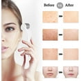thumbnail image 5 of Rodillo de microagujas -1 mm 1 pieza, rodillo de microagujas facial fabricado en titanio, adecuado para una piel suave y hermosa, adecuado para una piel joven y brillante, 5 of 5