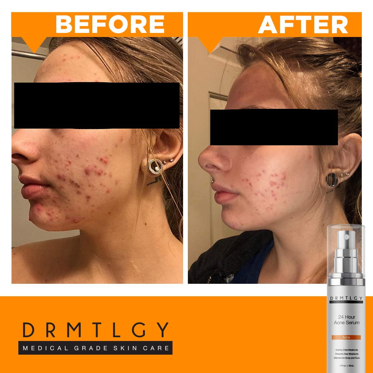 cystic acne serum