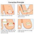 thumbnail image 1 of Juego De Herramientas De Pedicura Profesional, Recortador De Uñas De Los Pies, Fijador De Corrección De Uñas Encarnadas, Cuidado De Los Pies, 1 of 7