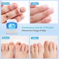 thumbnail image 3 of Dispositivo láser antimicótico para eliminar hongos en las uñas de los dedos de los pies, tratamiento láser para hongos en las uñas, tratamiento casero para onicomicosis, 3 of 4