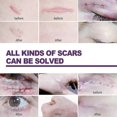 thumbnail image 3 of EELHOE 40*150mm x 4Pcs Adhesive Silicone Scar Sheets Safety Mild Fade Scar Scar Reduction Therapy, 3 of 5