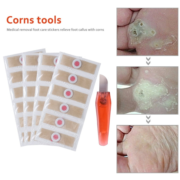 Foot Corn Removal — Bottom of Foot Callus Removal