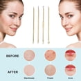 thumbnail image 3 of Blackhead Remover Tool, Blackhead Extractor tool for Face, Extractor Tool for Zit Acne, 3 of 5
