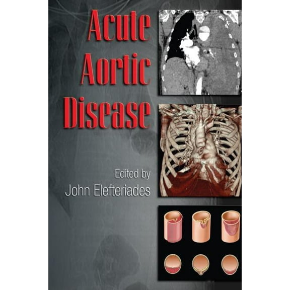 Fundamental and Clinical Cardiology Acute Aortic Disease, Book 61, (Hardcover)