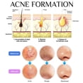 thumbnail image 5 of Teenitor Pimple Extractor Acne Treatment Tool Surgical Grade Blackhead Comedone Removal 2-In-1 Popper Tool For Face Nose, 5 of 5