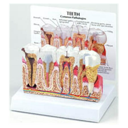 WP000-PT -2860 2860 Model Diseased Teeth & Gum 6x6x5.5 Ea Galloway