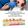 thumbnail image 4 of Modelo de caries dental, 6 etapas diferentes, modelo de exhibición de dientes cariados de resina, 4 of 8