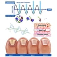 thumbnail image 3 of 2024 Nuevo, dispositivo láser para hongos en las uñas, terapia con luz, tratamiento de onicomicosis para los dedos de los pies, 910 nm - SNNGV, 3 of 5