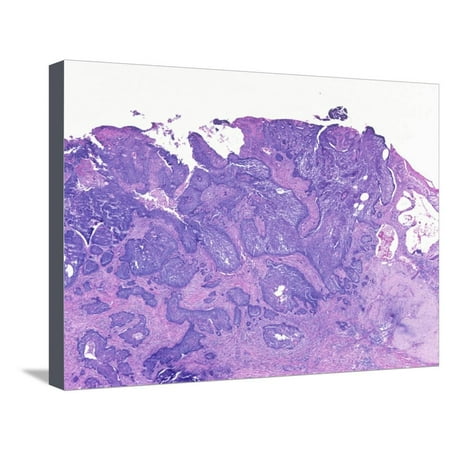 Human Skin Section of a Patient with Basal Cell Carcinoma Stretched Canvas Print Wall Art By Michael